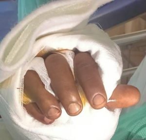 Severed thumb and broken bones due to a firecracker injury, successfully realigned at Manipal Hospital Dhakuria…